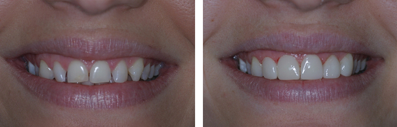 before-and-after-veneers