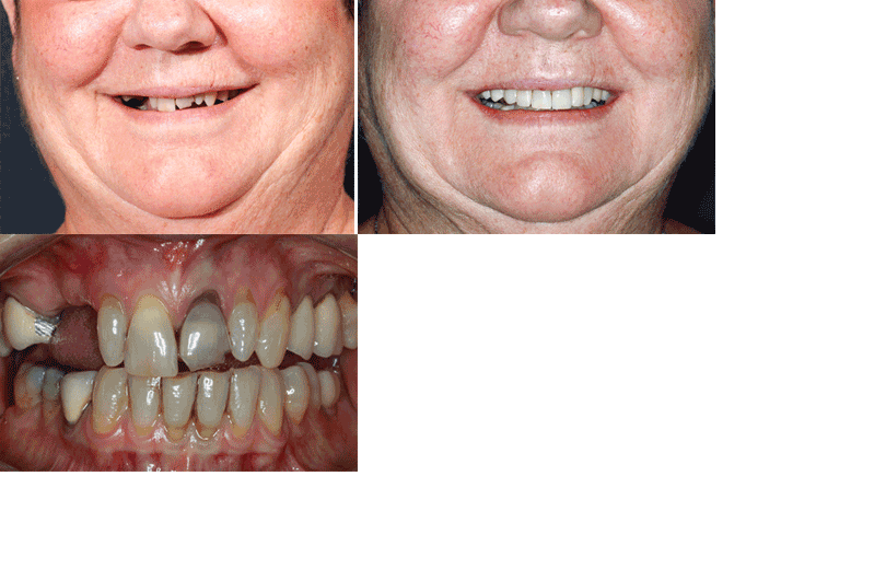 dental-implants-lady