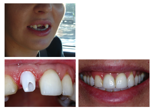 Dental Implant treatment | The Smile Pros