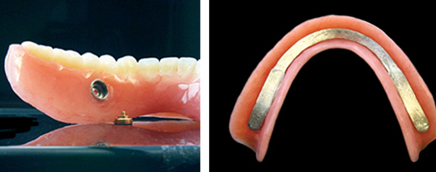 What is a suction denture and do they help?