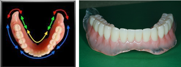 What is a suction denture and do they help? | Smile Pro Dental